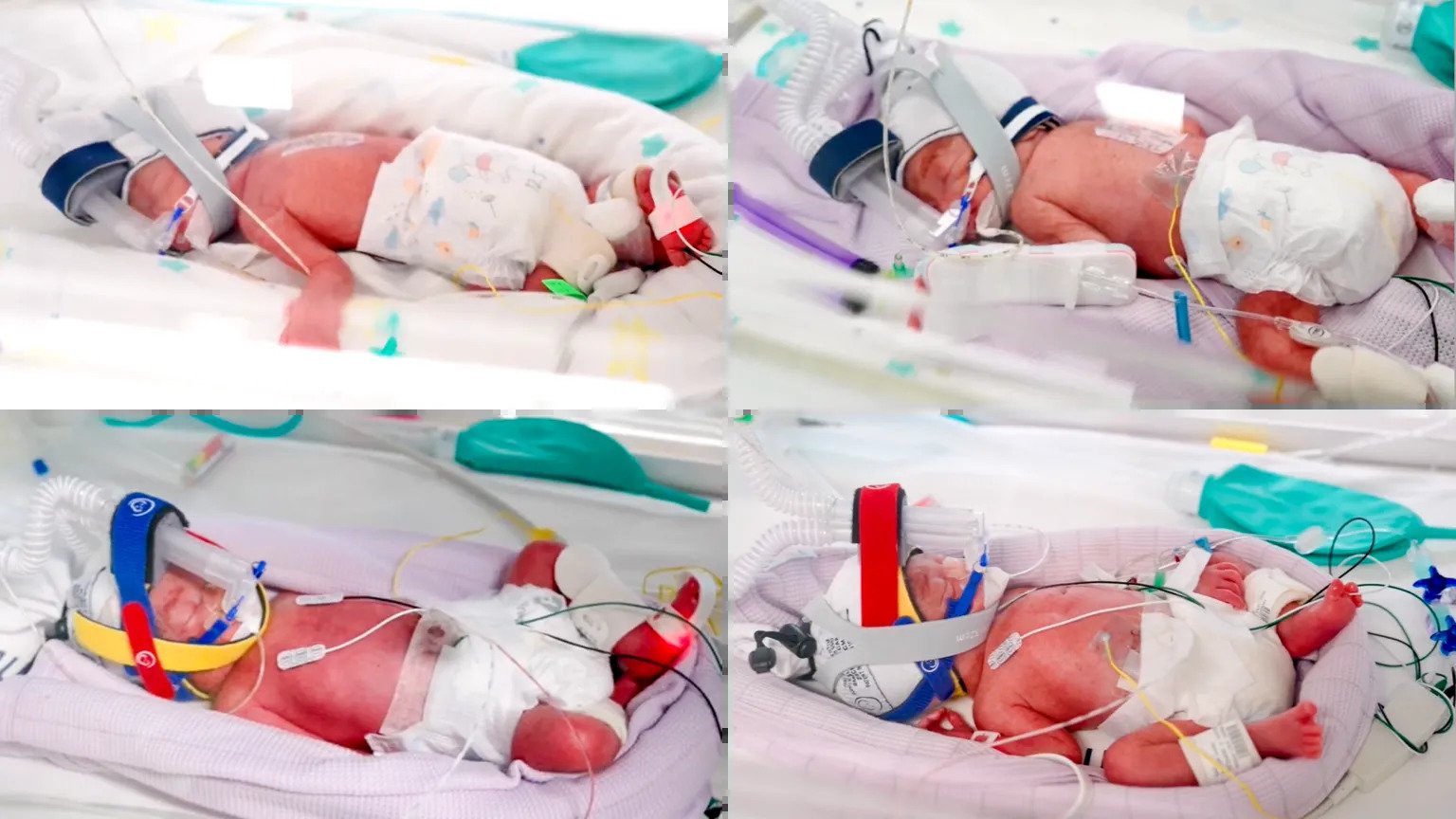 Naturally Conceived Identical Quadruplets Born in Rare Brisbane Delivery